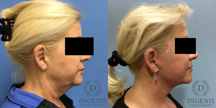 Facelift: Patient 12 - Before and After 3