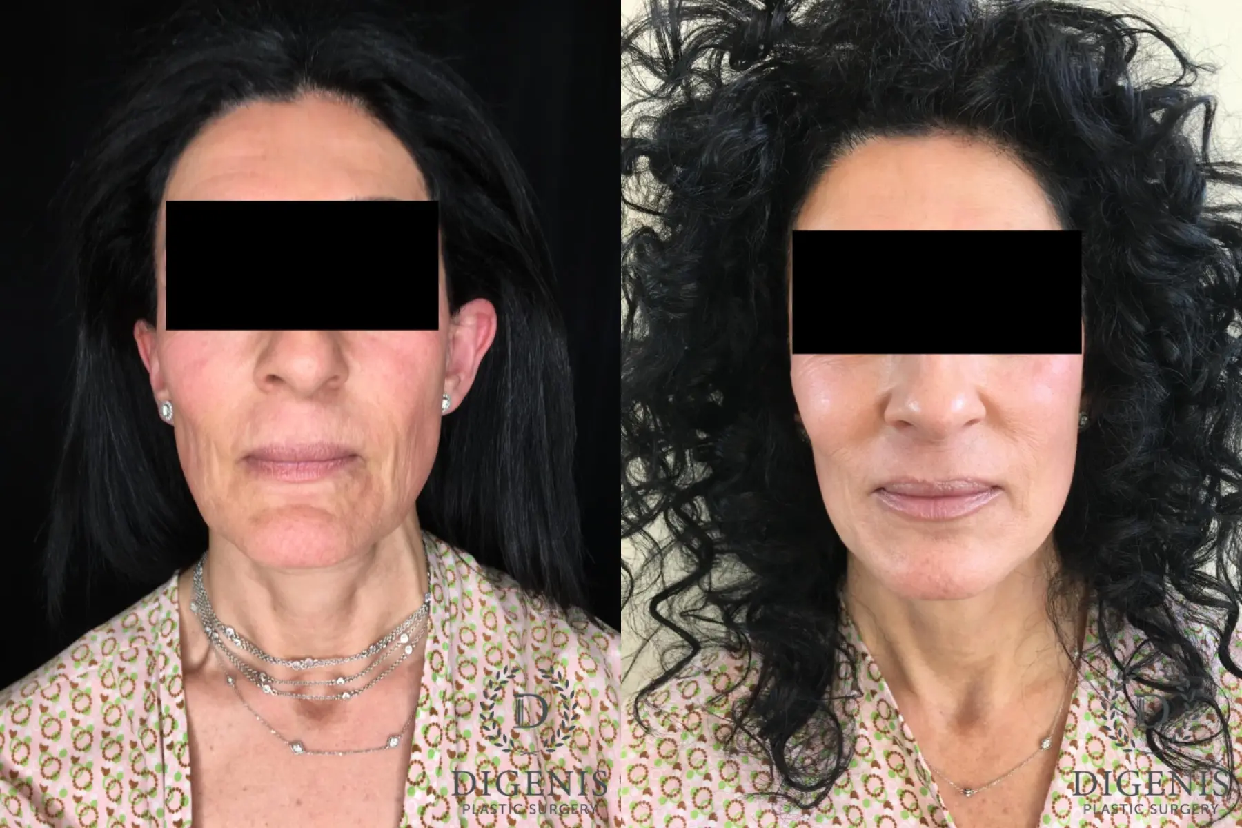 Facelift: Patient 28 - Before and After  