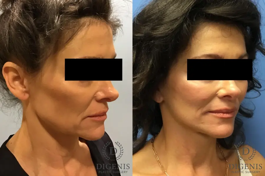 Facelift: Patient 9 - Before and After 4