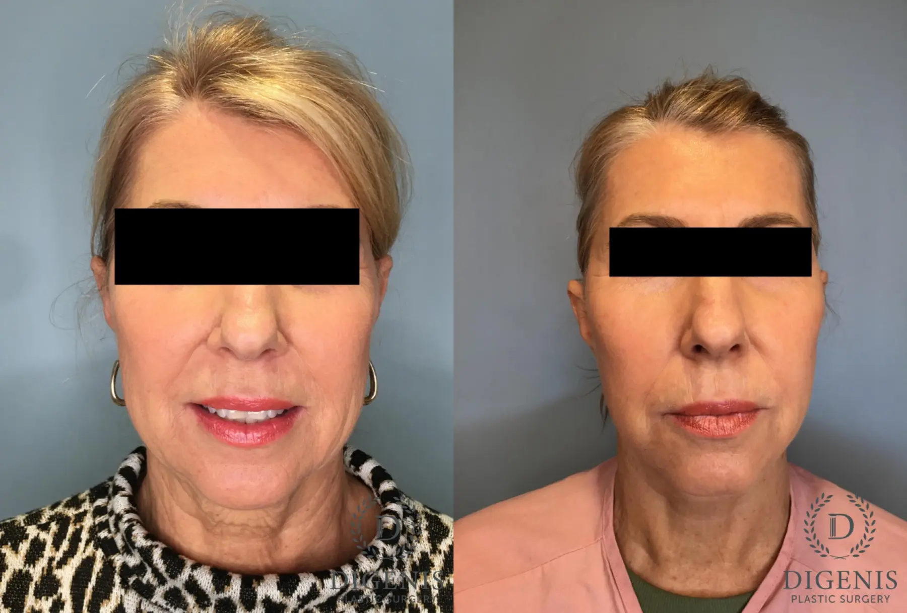 Facelift: Patient 15 - Before and After  