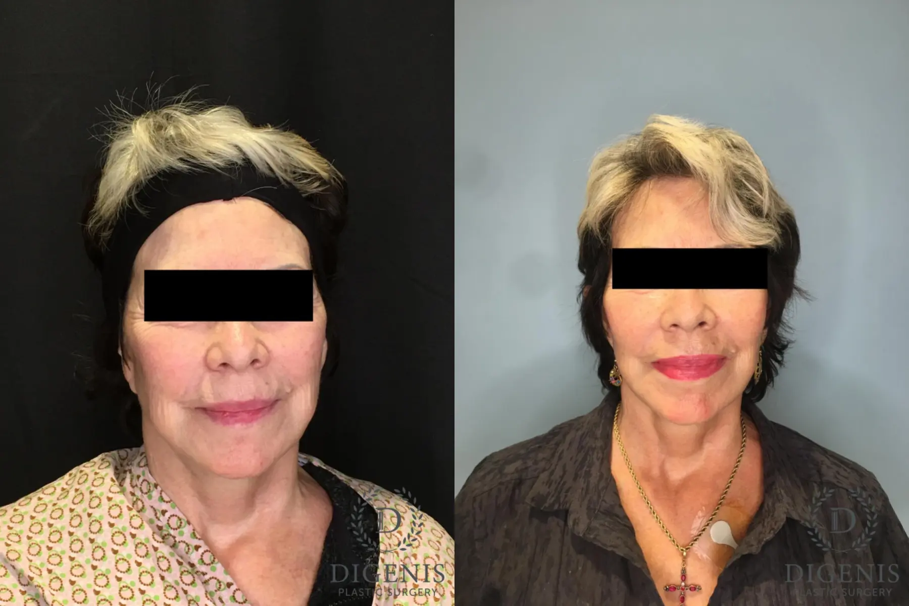 Facelift: Patient 29 - Before and After 1