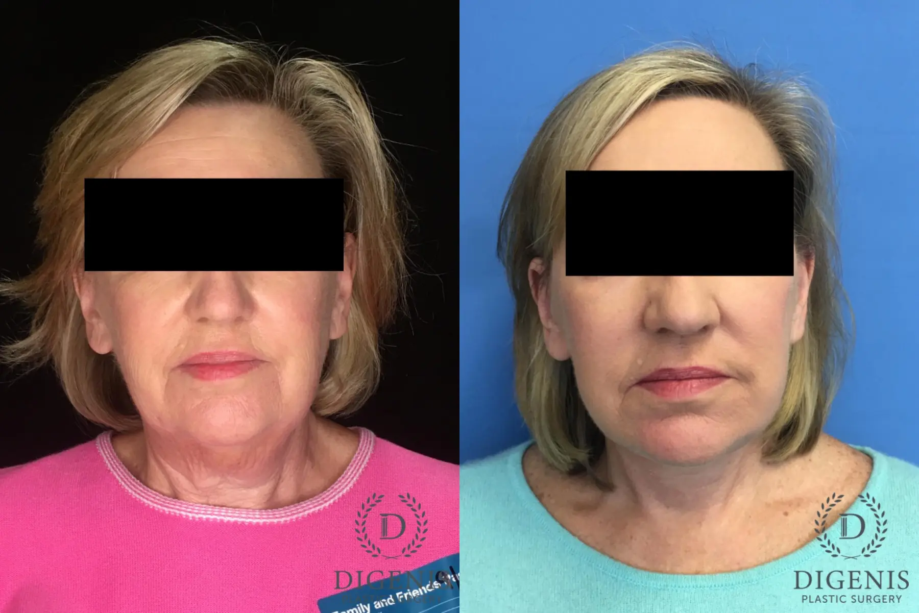 Facelift: Patient 3 - Before and After  