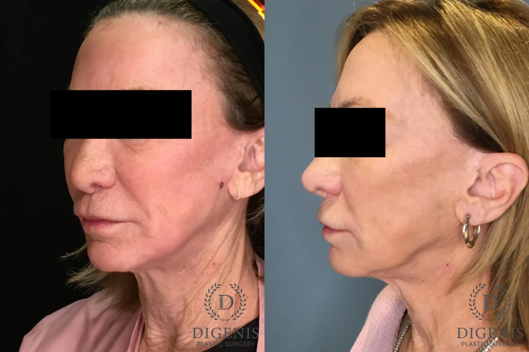 Facelift: Patient 64 - Before and After 2