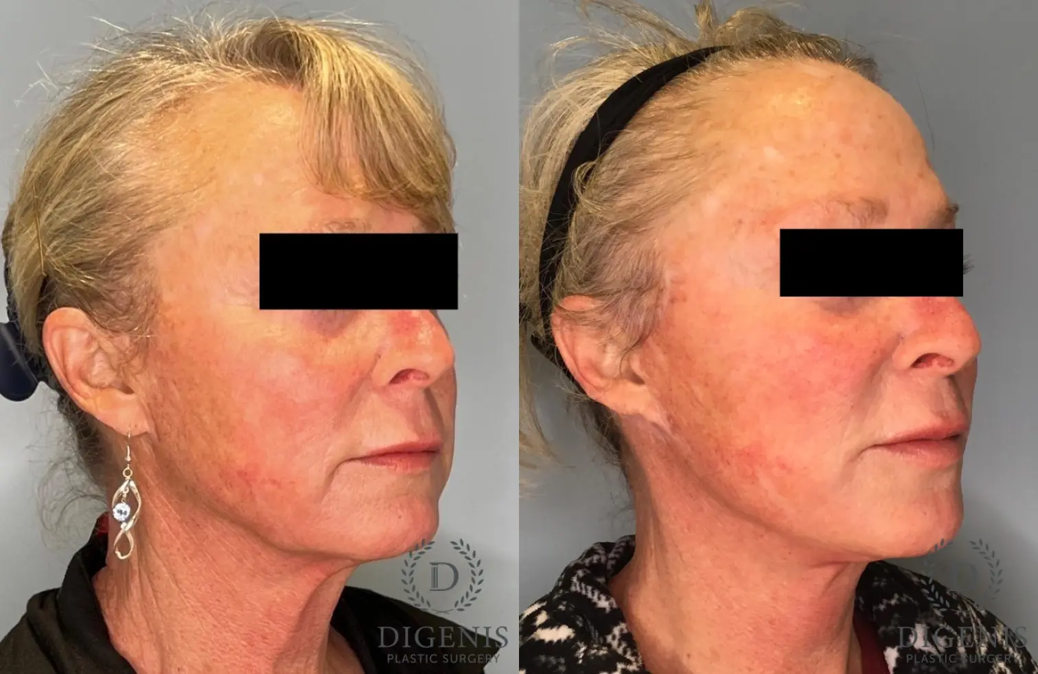 Facelift: Patient 17 - Before and After 2