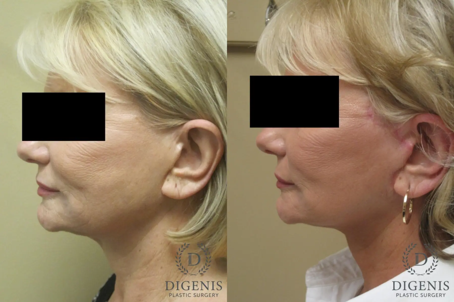 Facelift: Patient 15 - Before and After 5