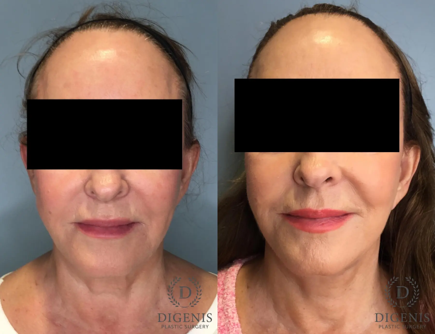 Facelift: Patient 33 - Before and After  