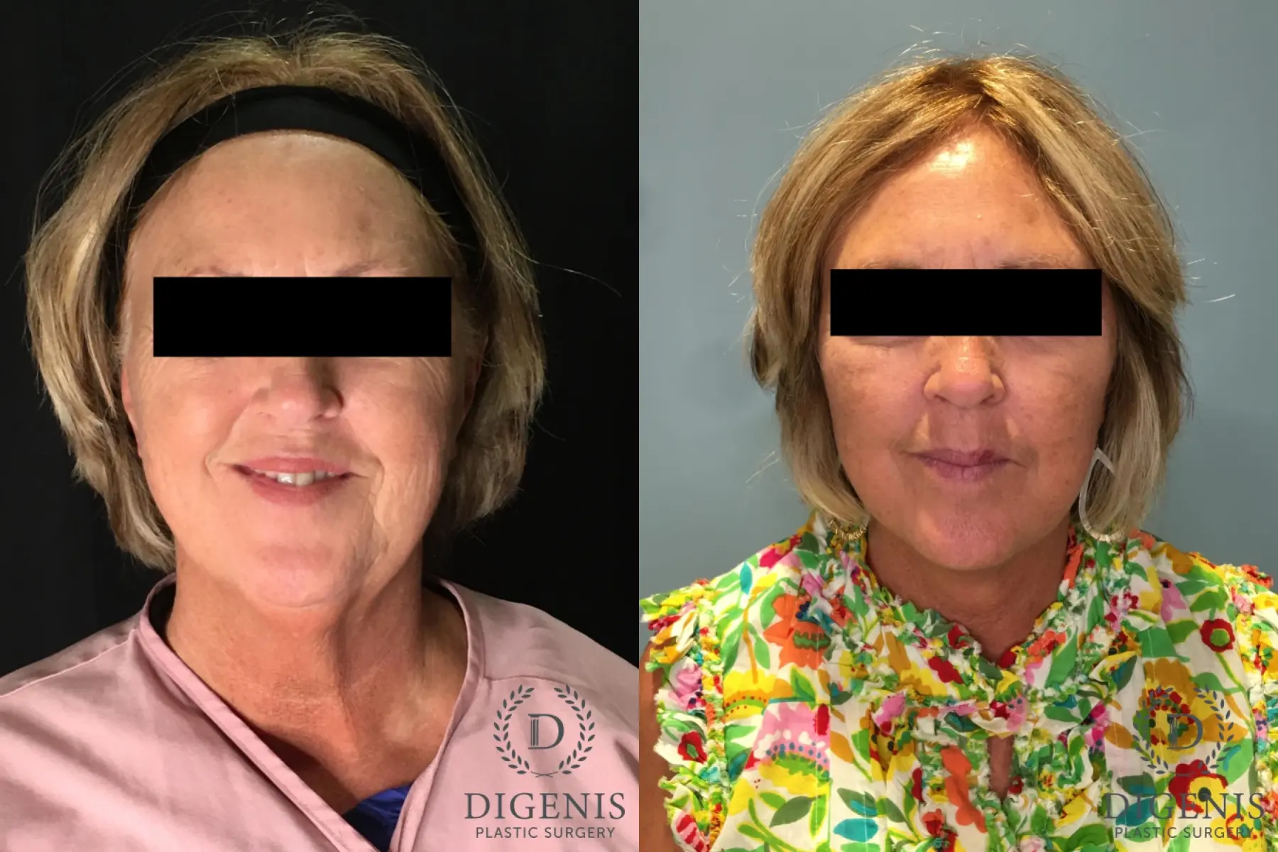 Facelift: Patient 27 - Before and After  