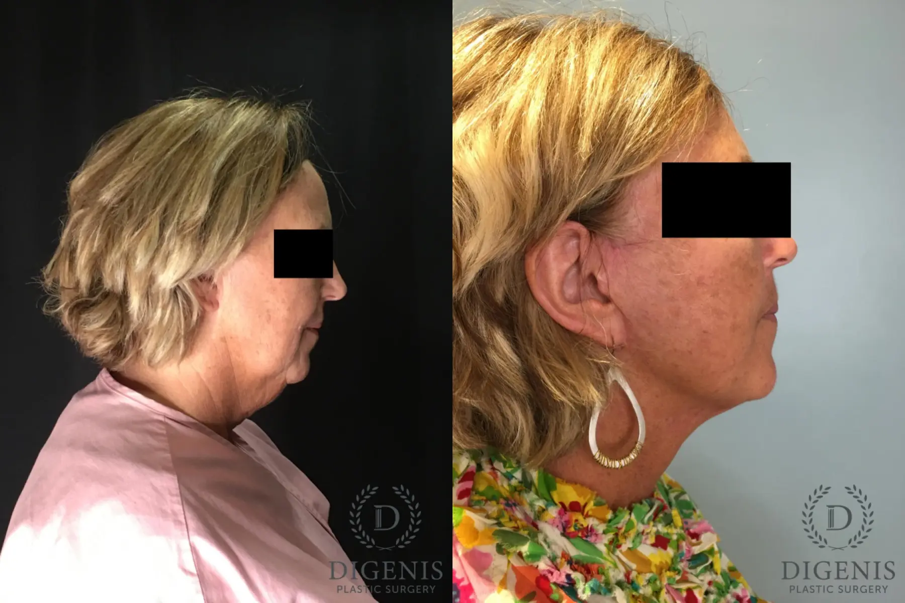 Facelift: Patient 27 - Before and After 3