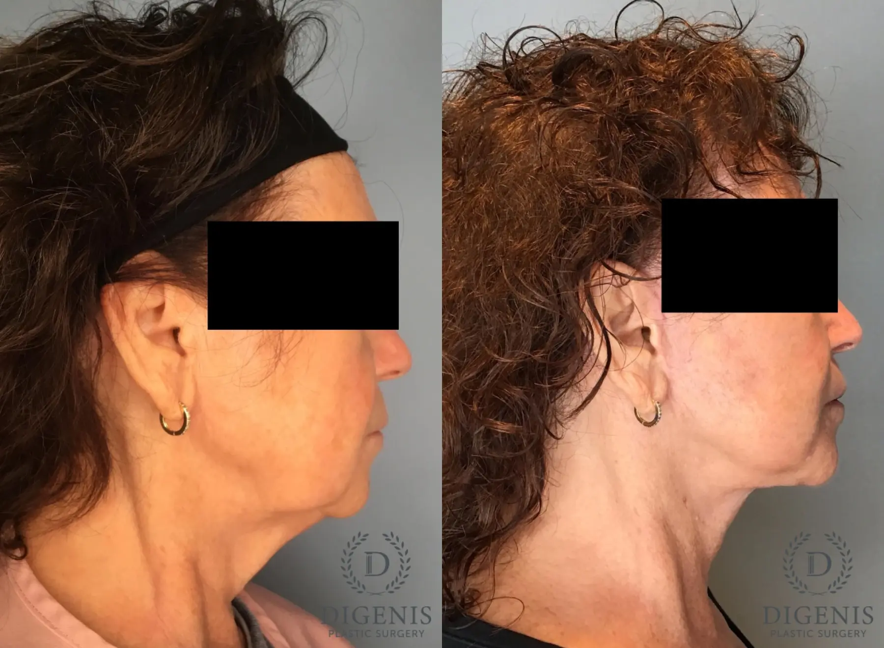 Facelift: Patient 71 - Before and After 5