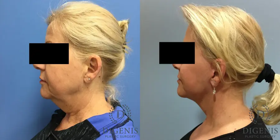 Facelift: Patient 12 - Before and After 5
