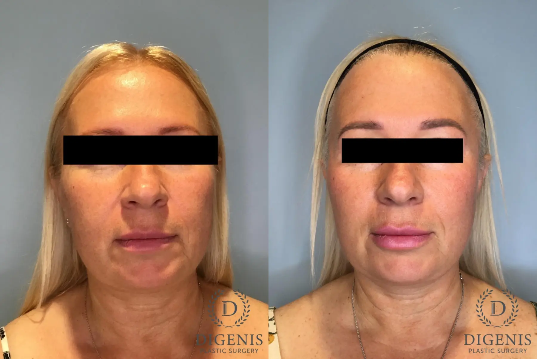Facelift: Patient 65 - Before and After 1