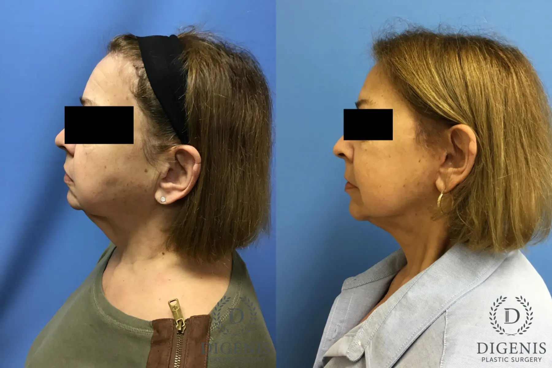 Facelift: Patient 8 - Before and After 5