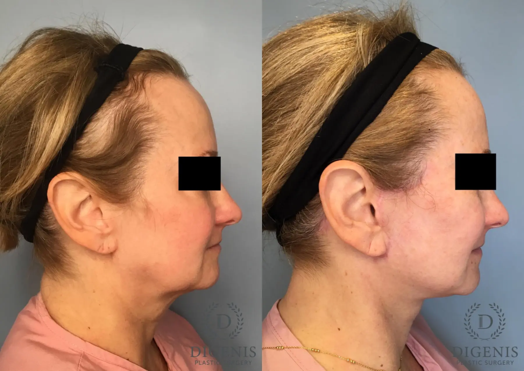 Facelift: Patient 13 - Before and After 3