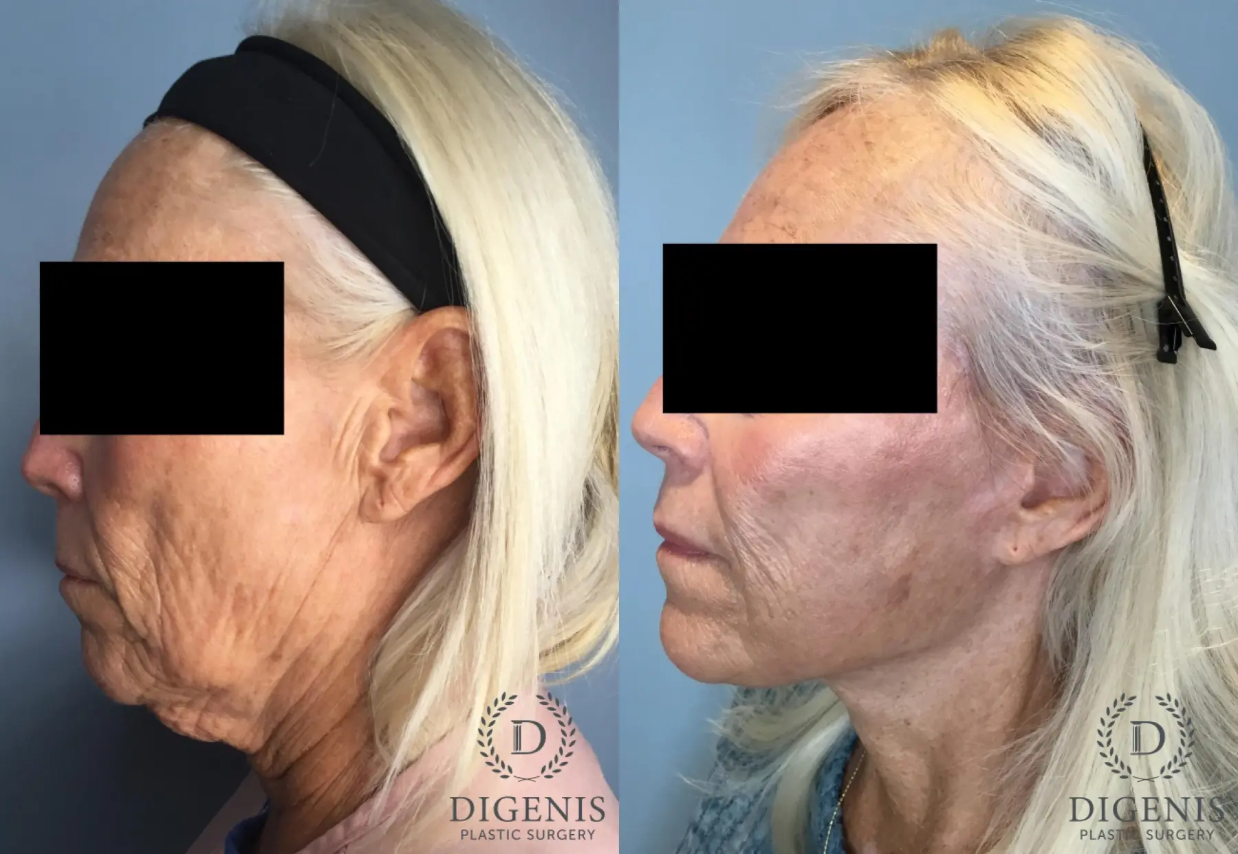 Facelift: Patient 63 - Before and After 3