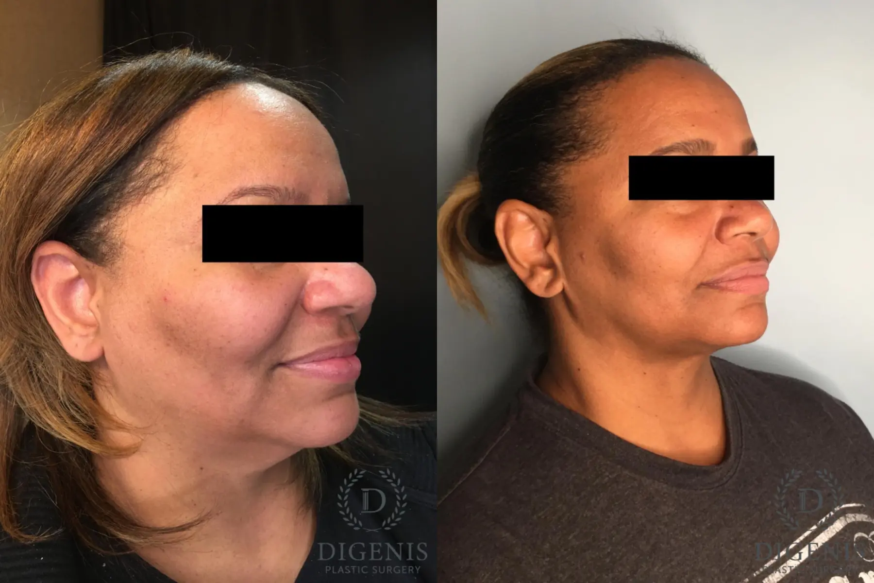 Facelift: Patient 63 - Before and After 2