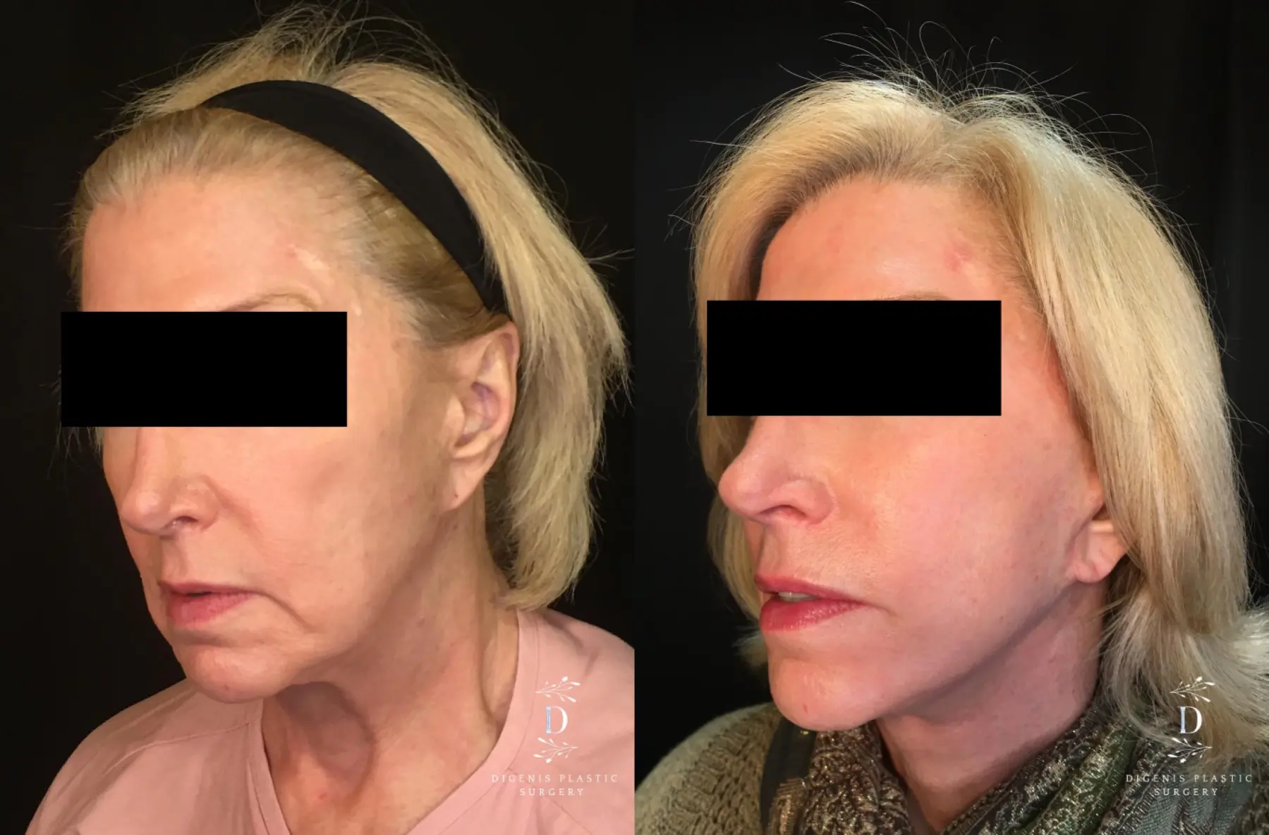 Facelift: Patient 21 - Before and After 4