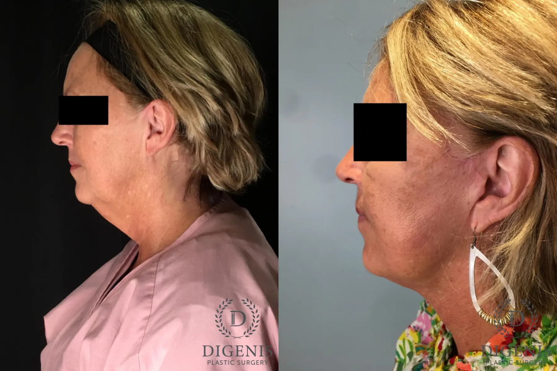 Facelift: Patient 27 - Before and After 5