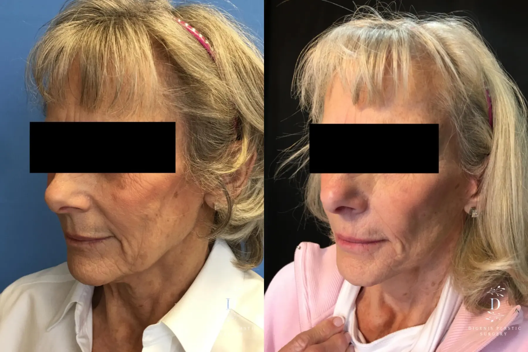 Facelift: Patient 19 - Before and After 3
