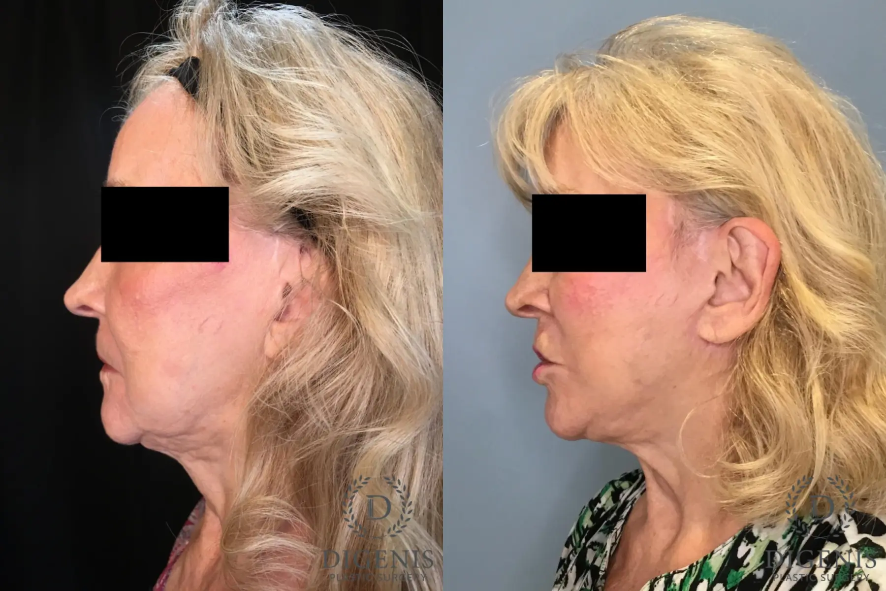 Facelift: Patient 24 - Before and After 4