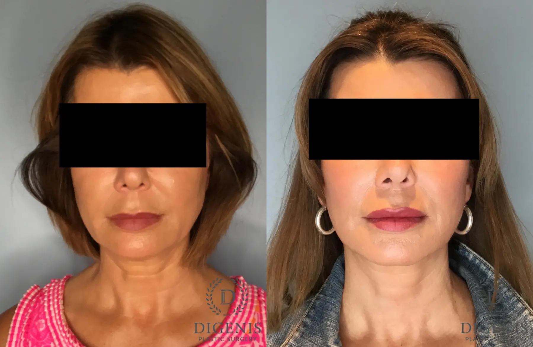 Facelift: Patient 72 - Before and After  