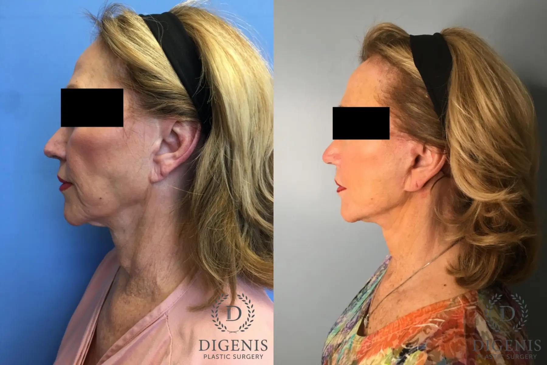 Facelift: Patient 25 - Before and After 5