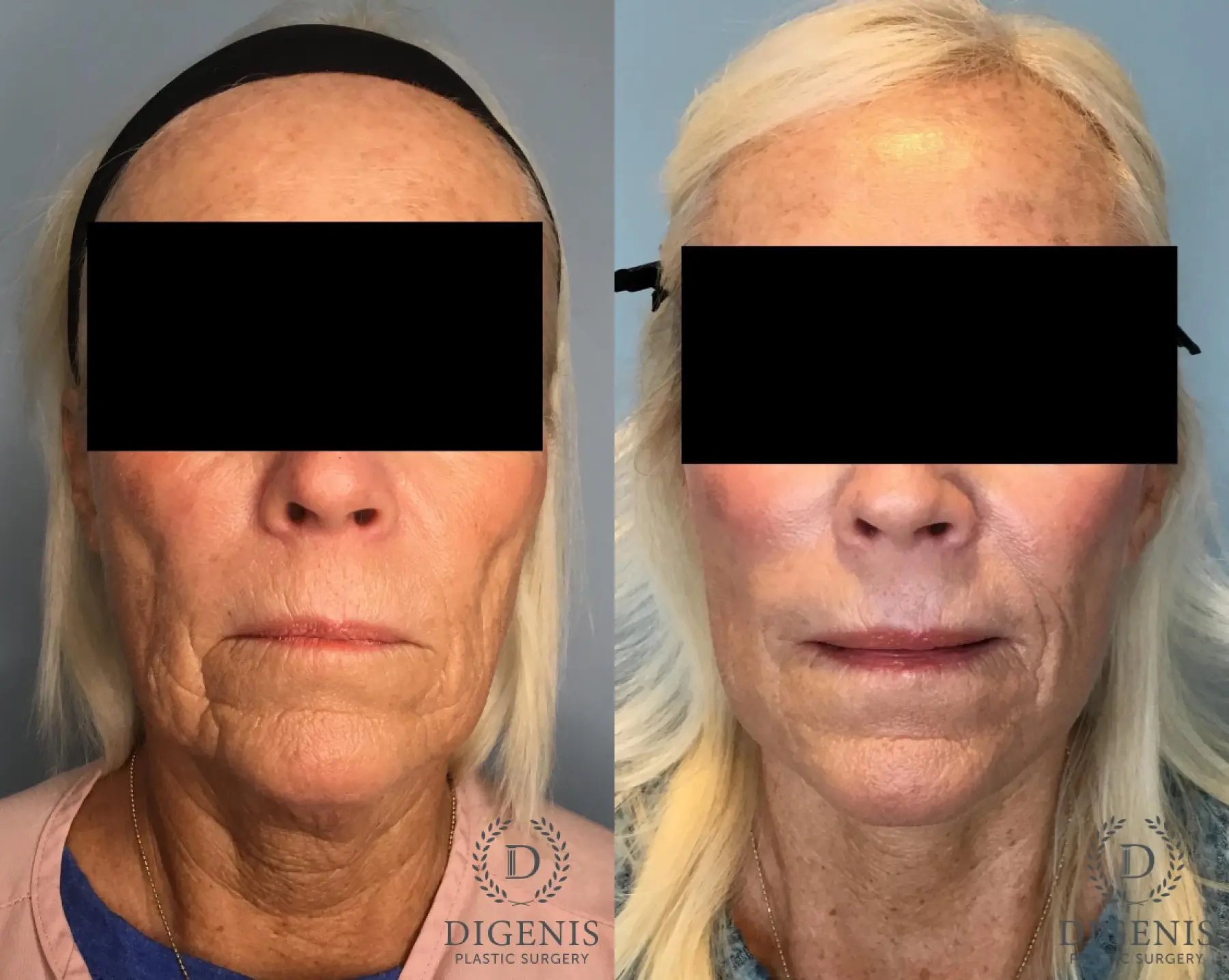 Facelift: Patient 63 - Before and After  