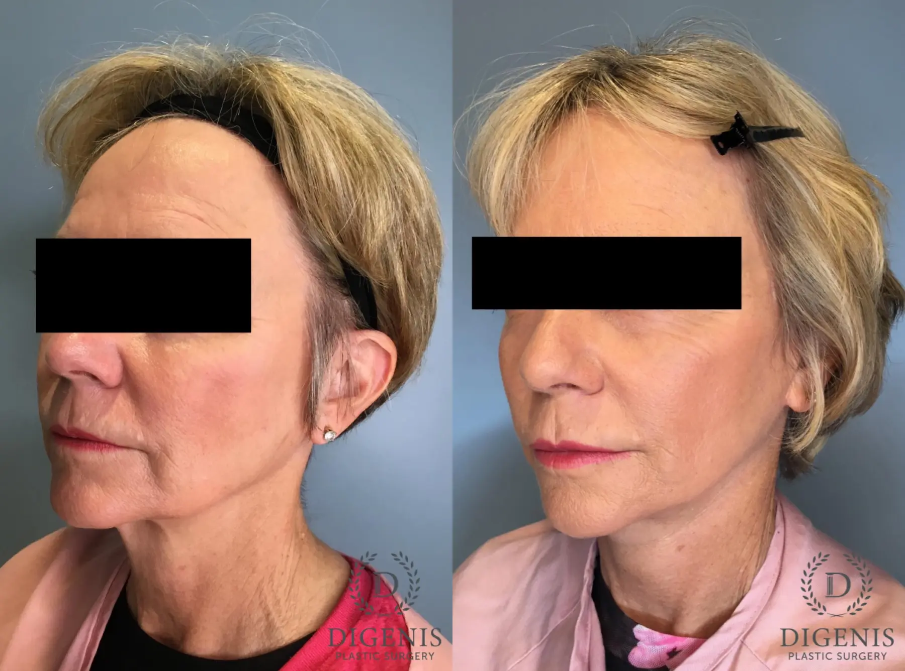 Facelift: Patient 14 - Before and After 2