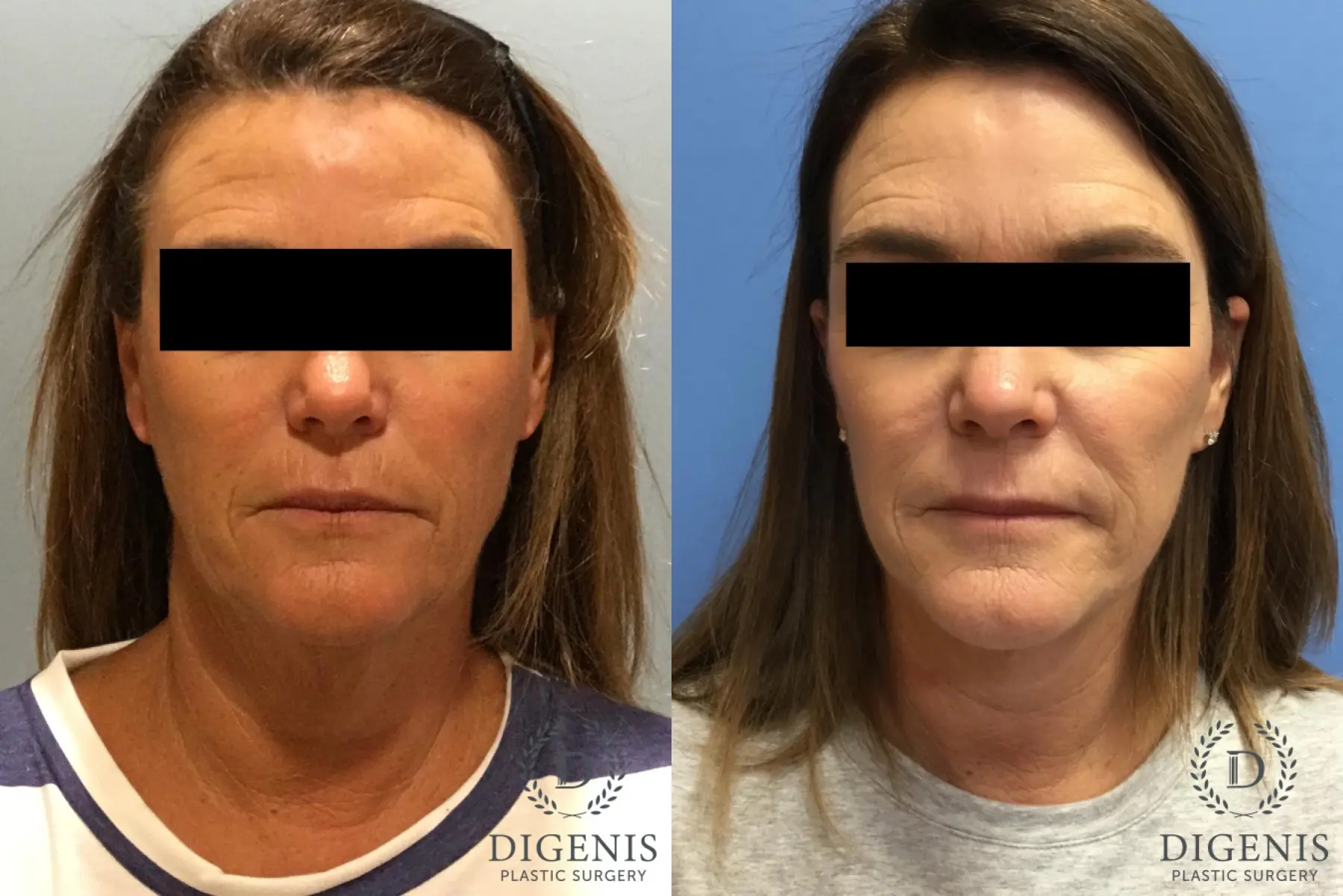 Facelift: Patient 12 - Before and After 1