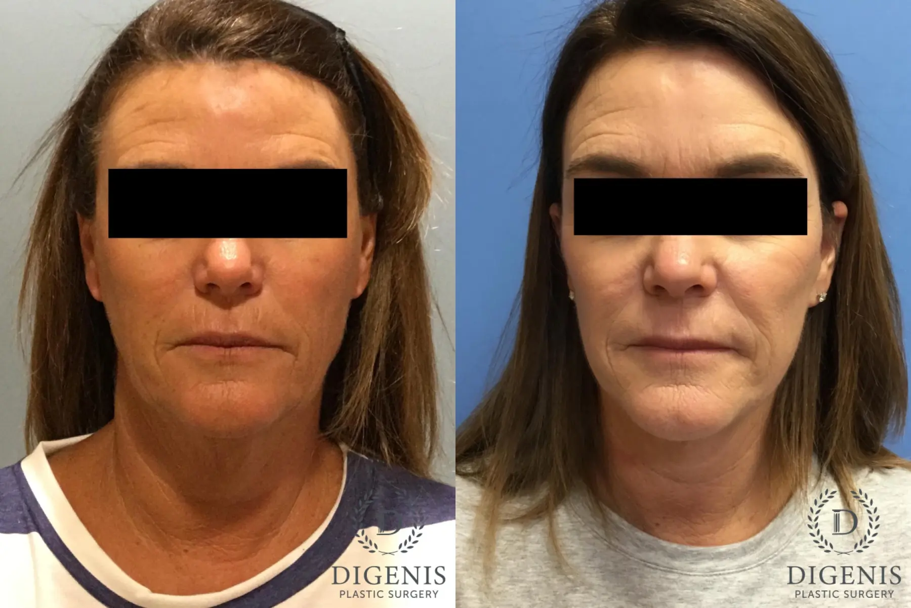 Facelift: Patient 12 - Before and After  