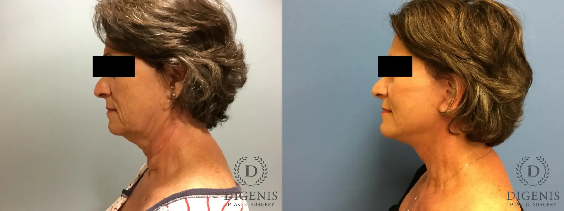 Facelift: Patient 15 - Before and After 5