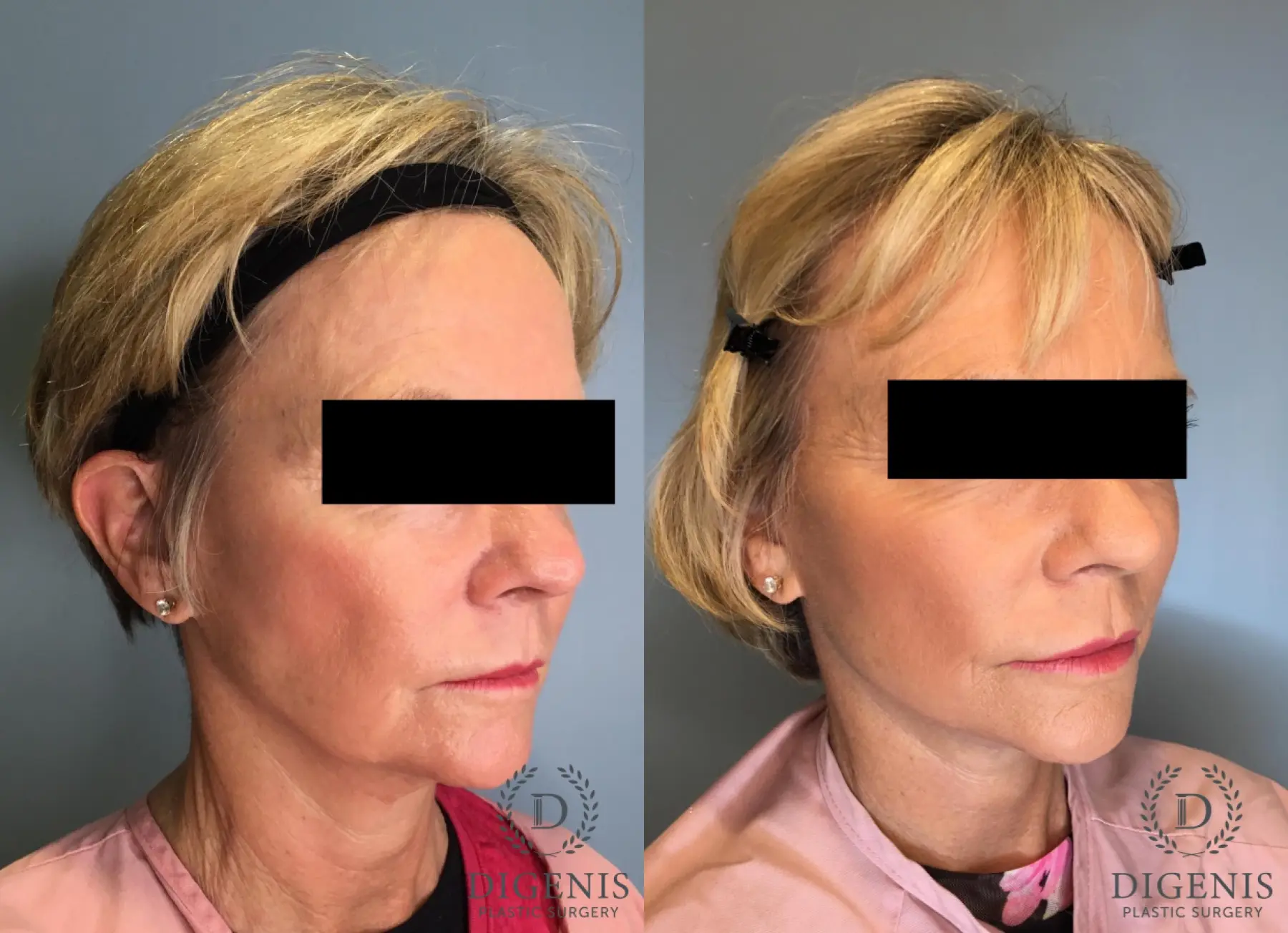 Facelift: Patient 14 - Before and After 4
