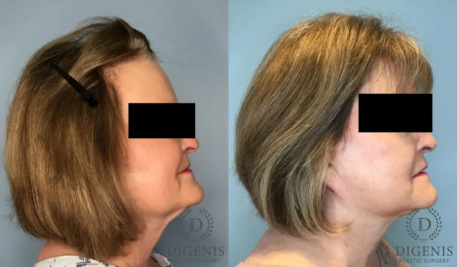 Facelift: Patient 62 - Before and After 3