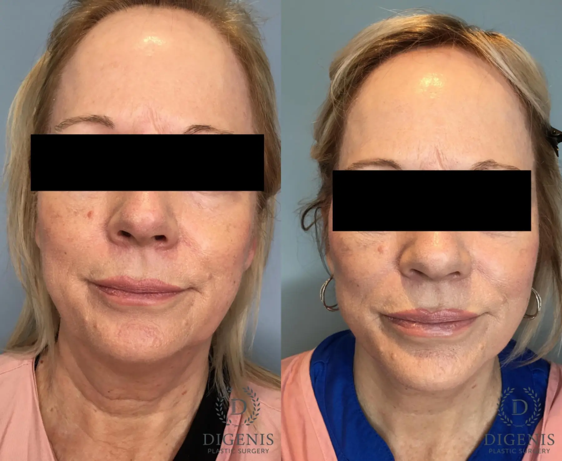 Facelift: Patient 66 - Before and After 1