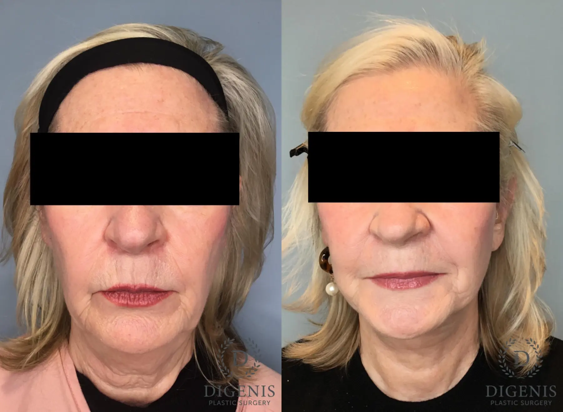 Facelift: Patient 67 - Before and After 1