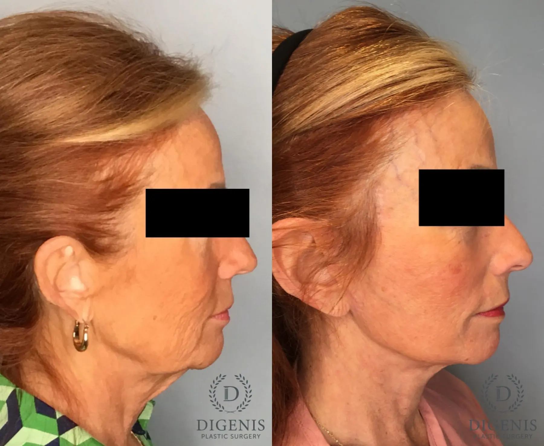 Facelift: Patient 25 - Before and After 4