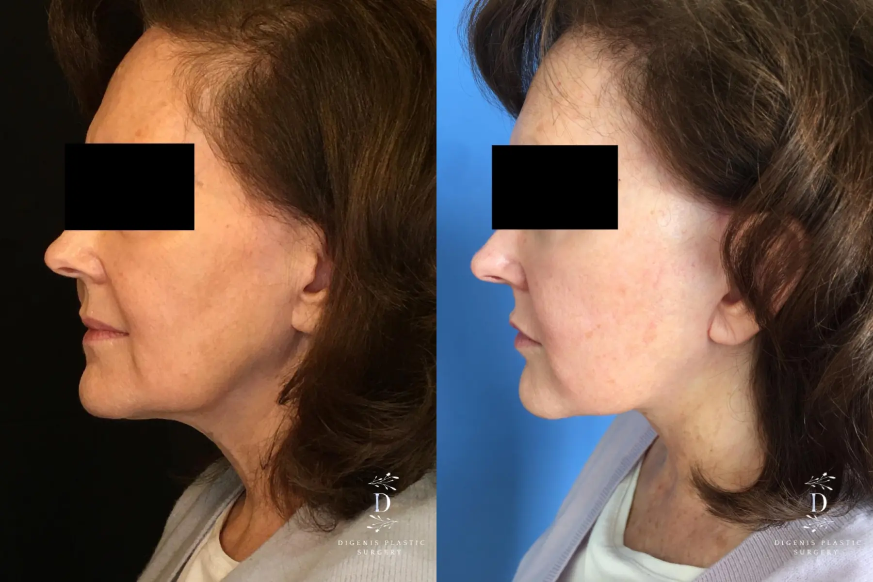 Facelift: Patient 18 - Before and After 4
