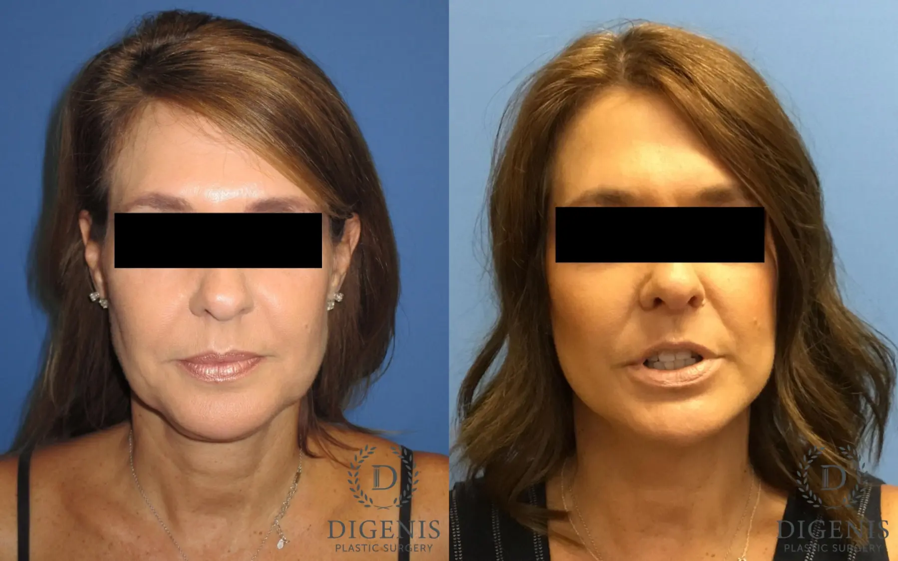 Facelift: Patient 11 - Before and After  