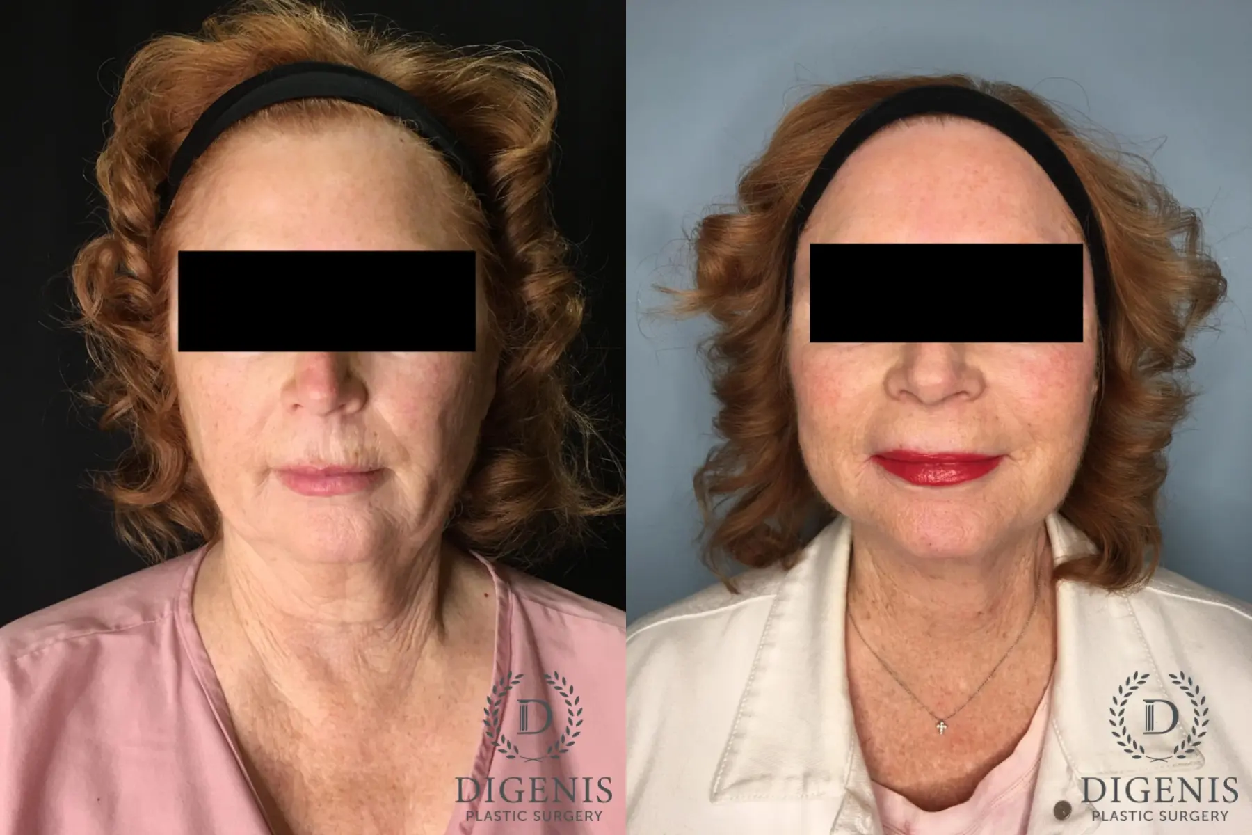 Facelift: Patient 2 - Before and After  