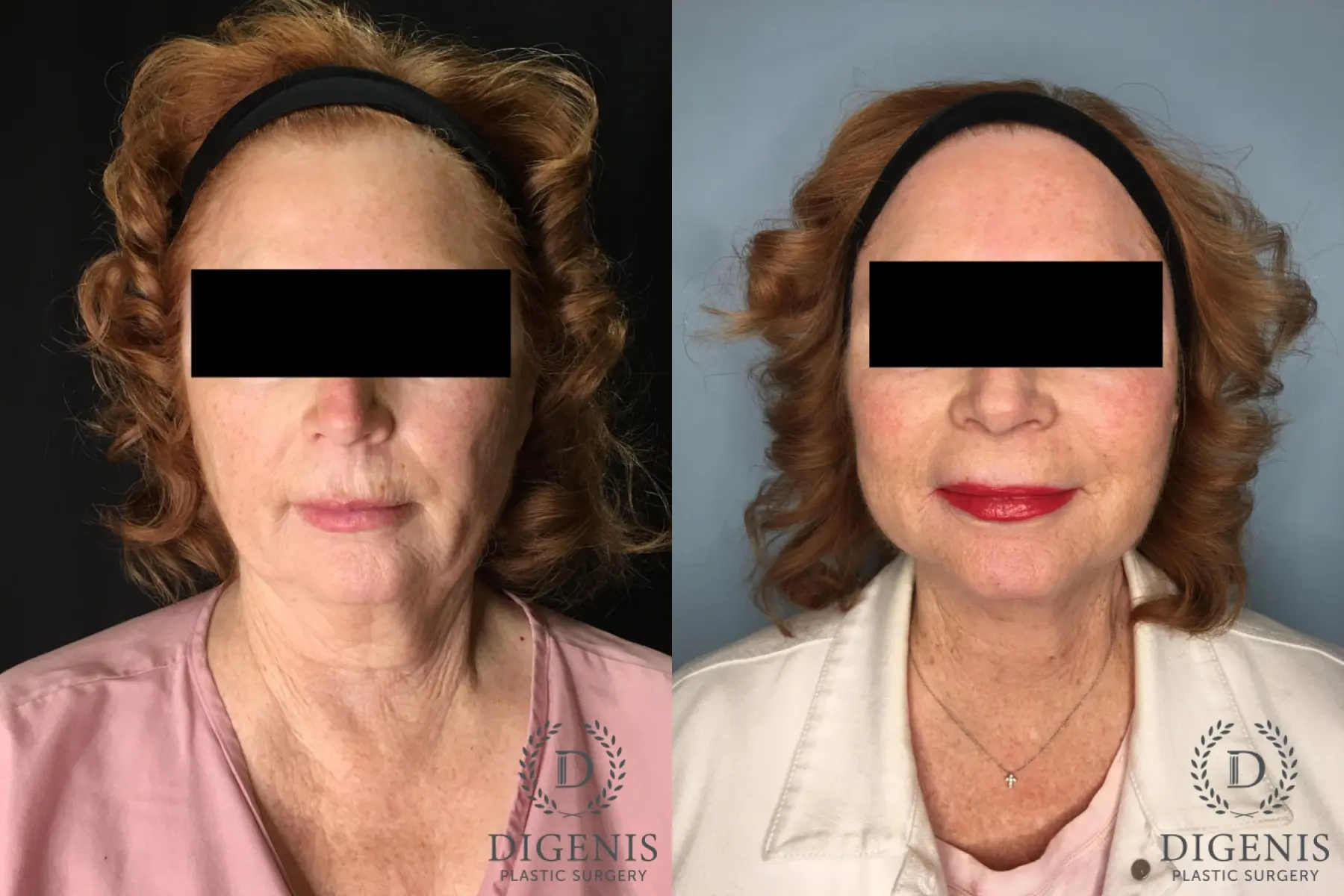 Facelift: Patient 5 - Before and After  