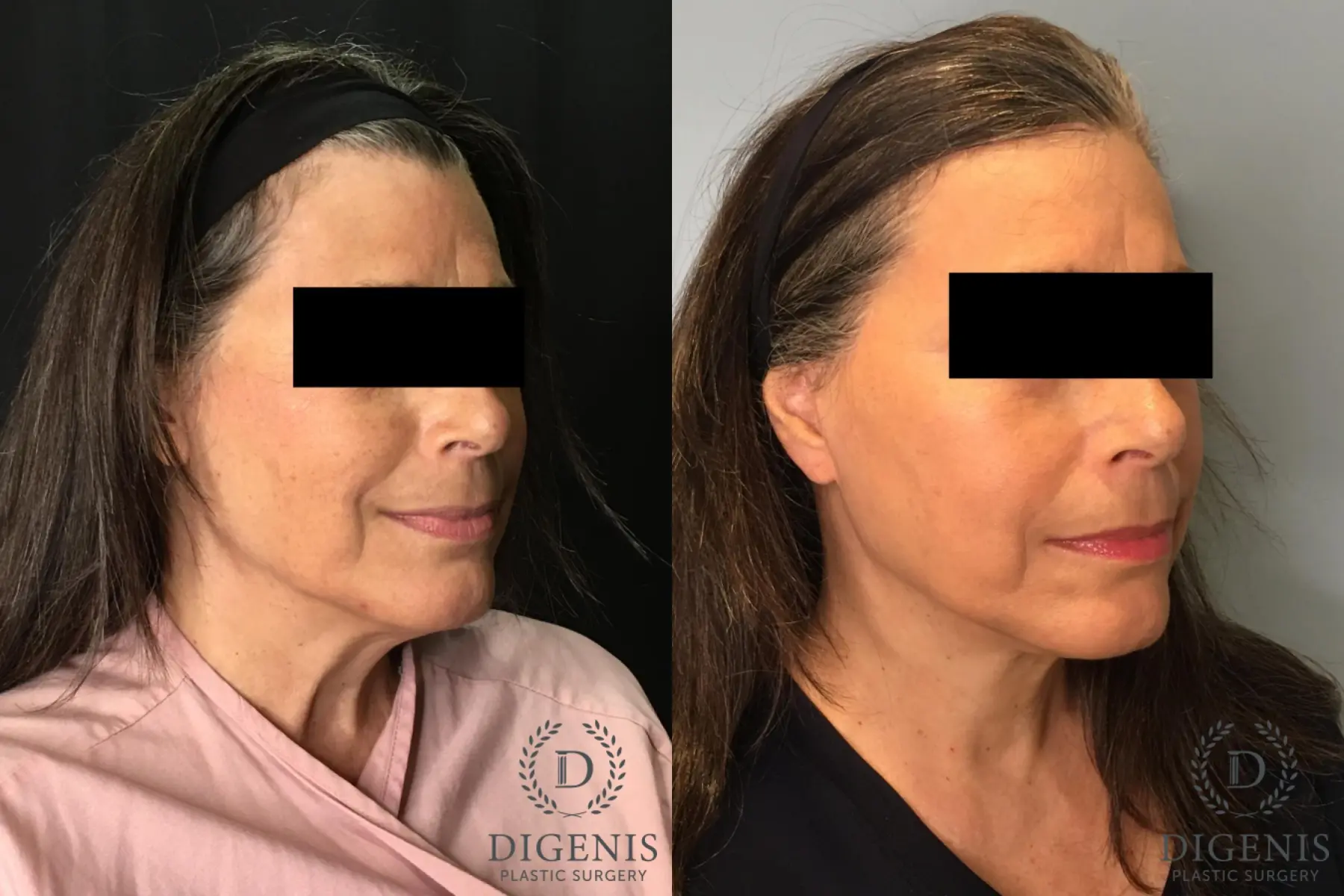 Facelift: Patient 26 - Before and After 2