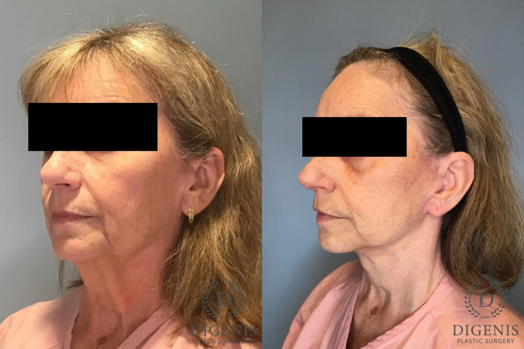 Facelift: Patient 20 - Before and After 2
