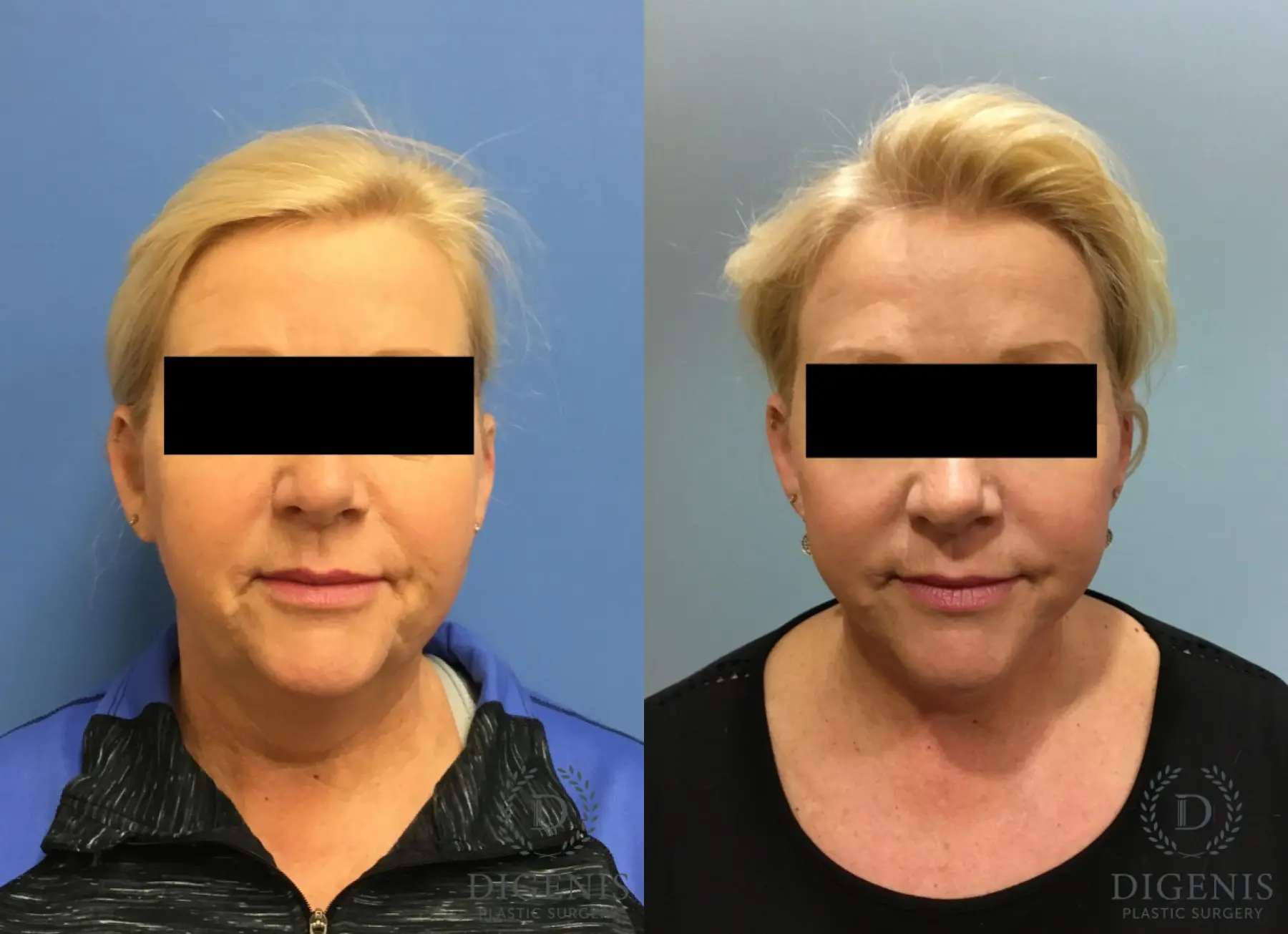 Facelift: Patient 13 - Before and After  