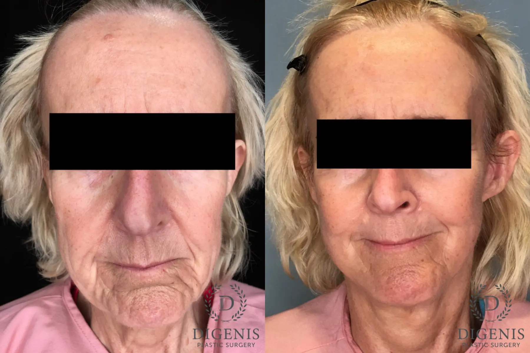 Facelift: Patient 36 - Before and After  