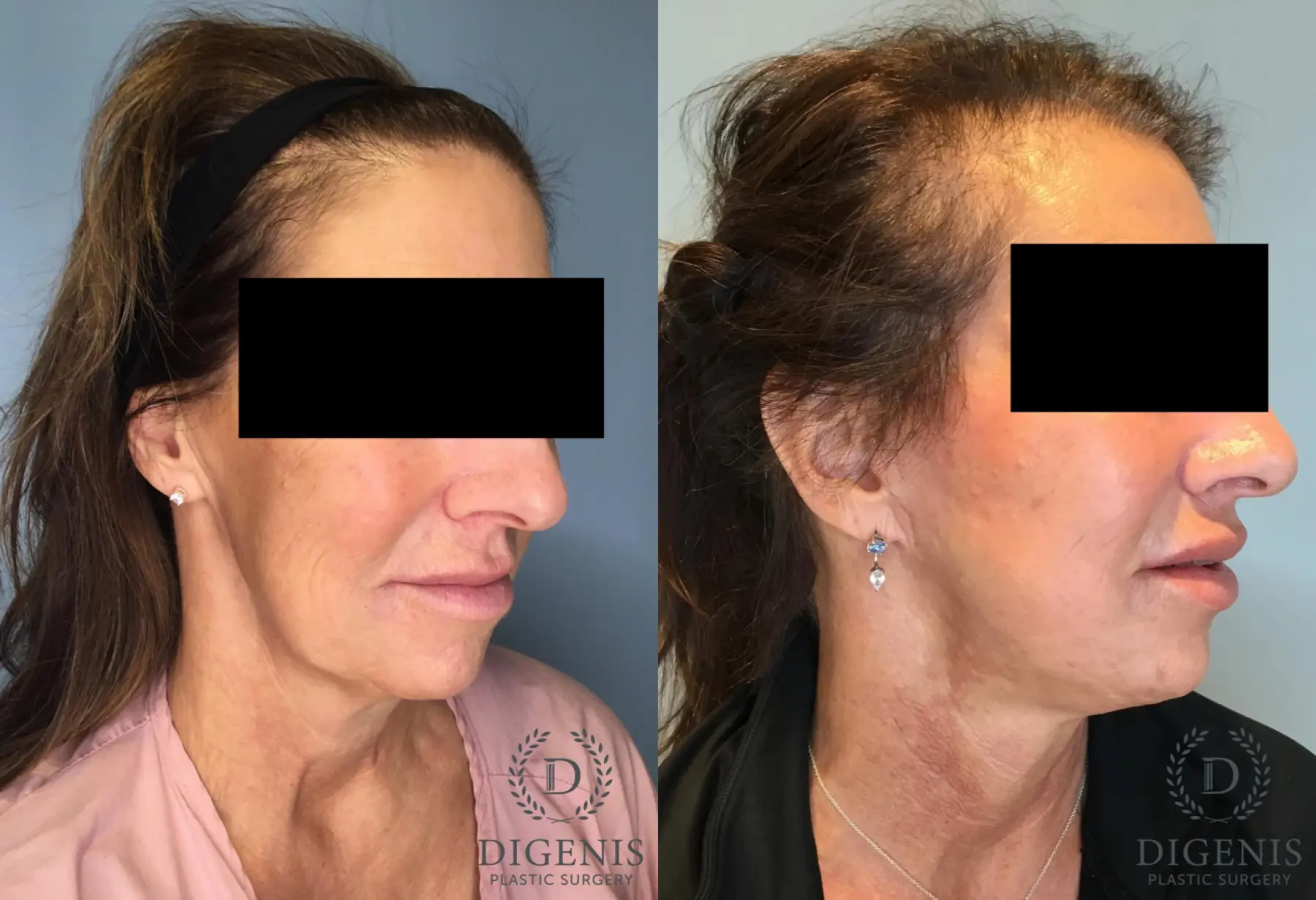 Facelift: Patient 62 - Before and After 2
