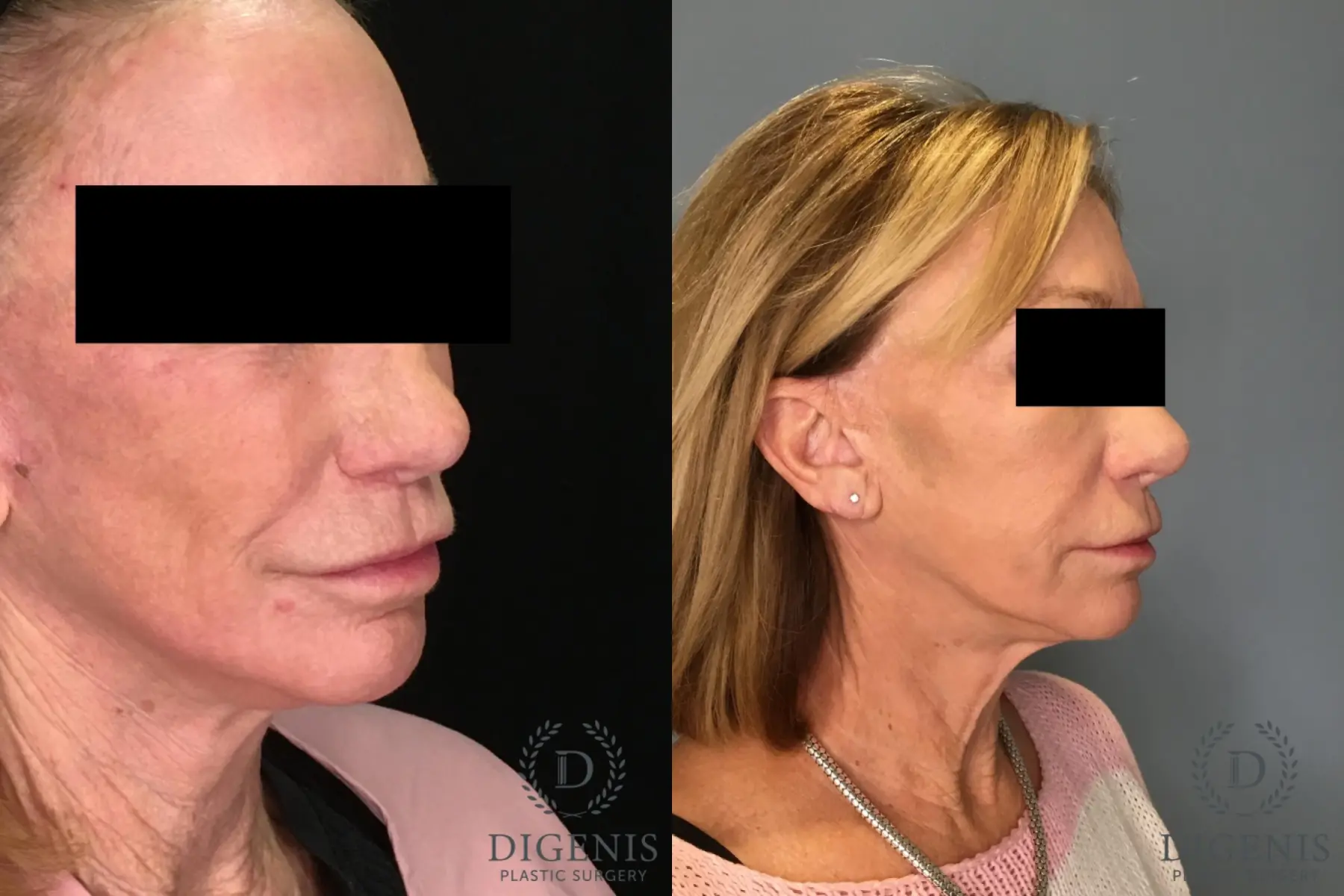 Facelift: Patient 64 - Before and After 4