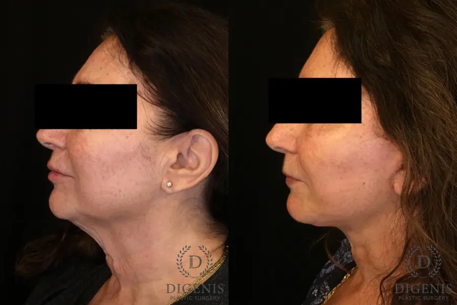 Facelift: Patient 4 - Before and After 4
