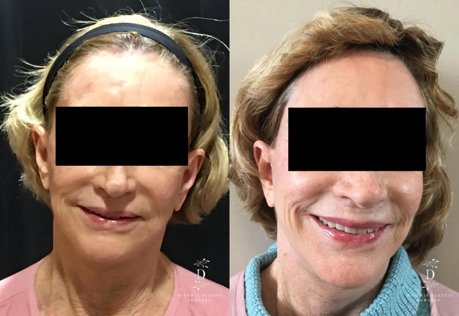 Facelift: Patient 22 - Before and After 1