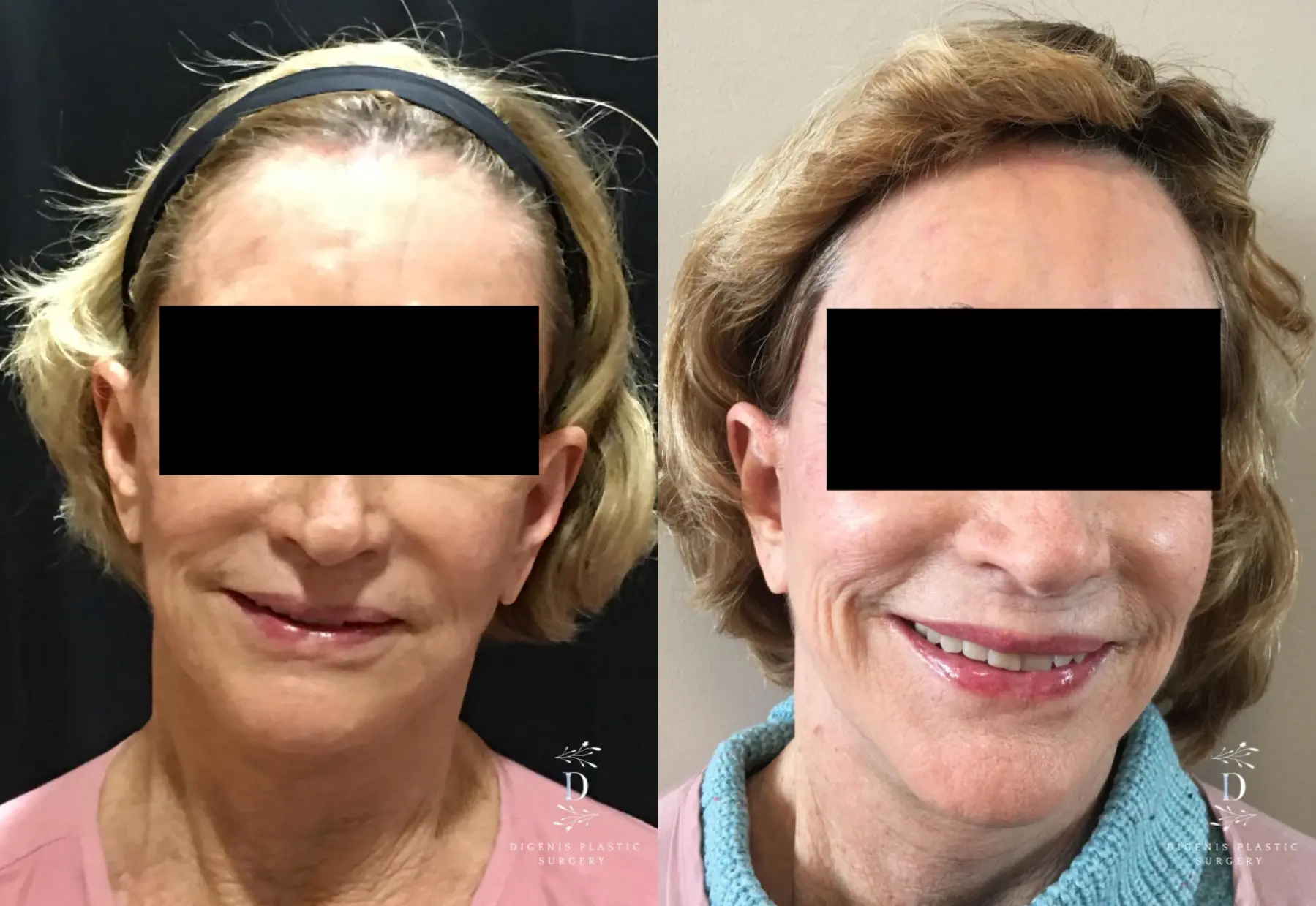 Facelift: Patient 23 - Before and After  