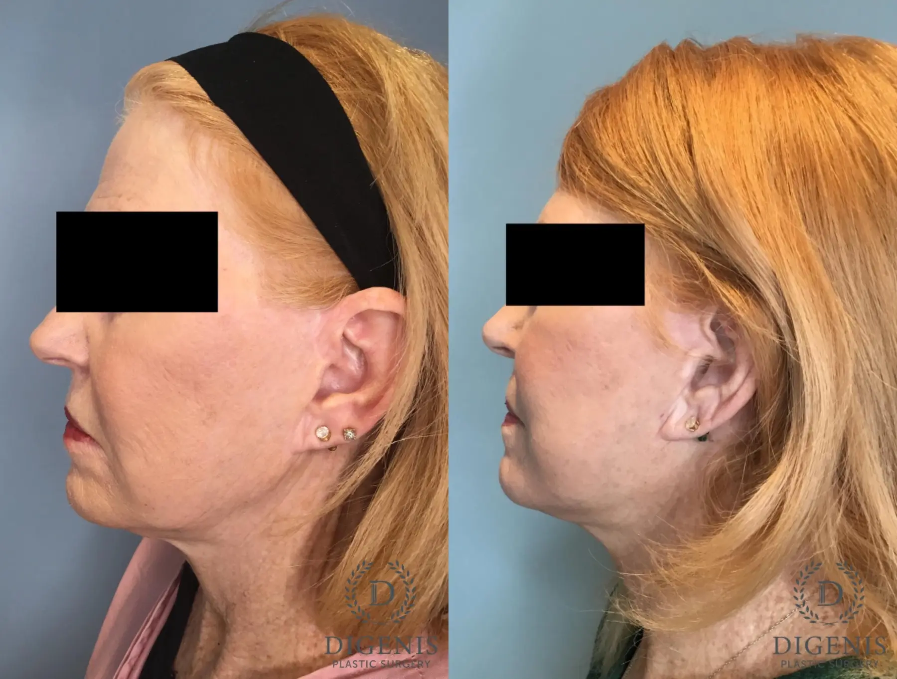Facelift: Patient 67 - Before and After 3