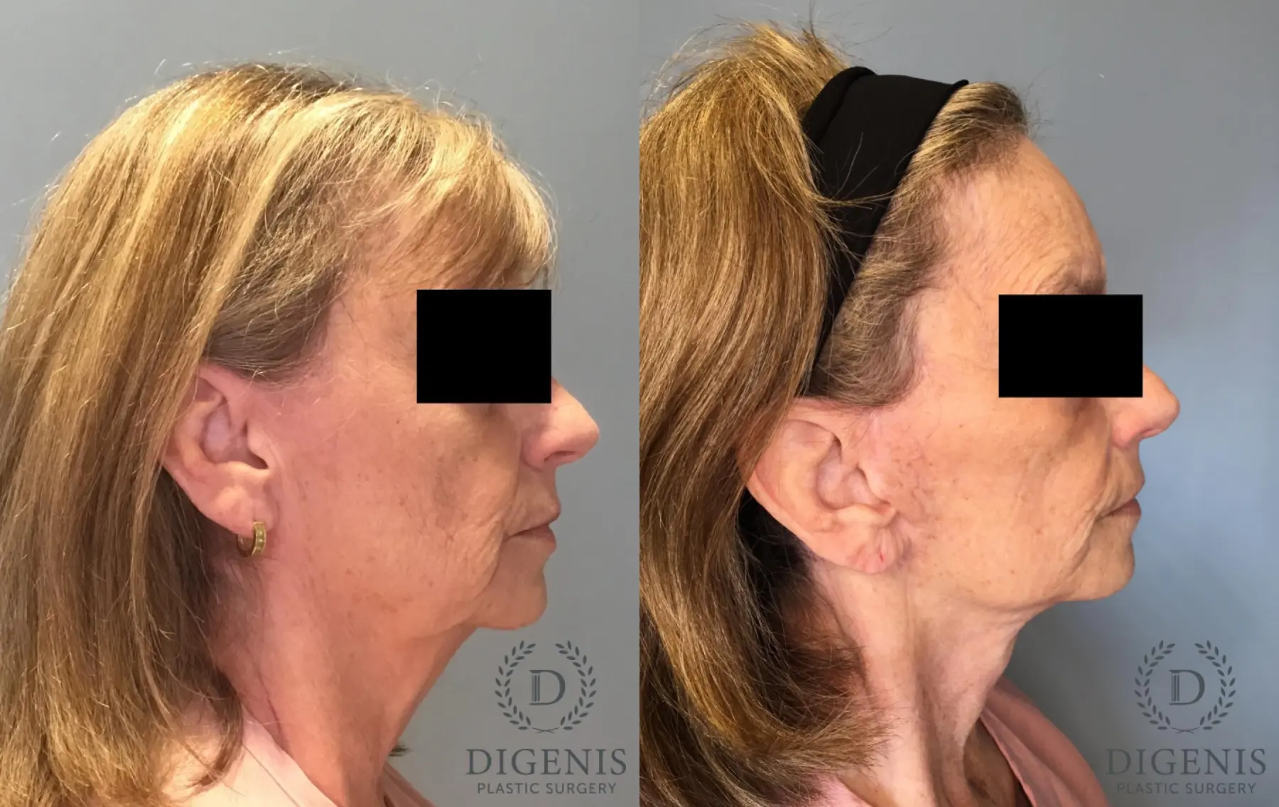 Facelift: Patient 20 - Before and After 5